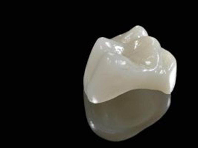 Featured image for “The Elegance of Porcelain Dental Crowns”