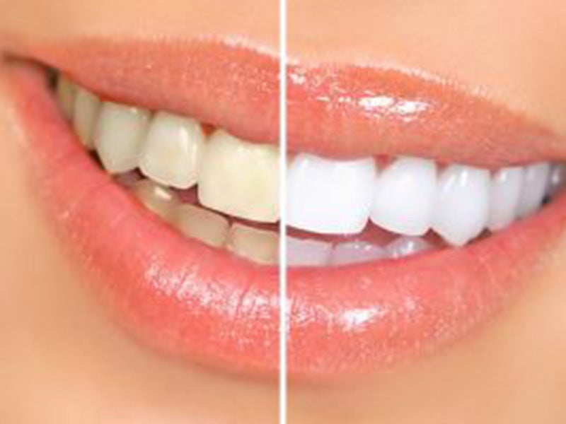 Featured image for “Five Reasons for Professional Teeth Whitening”