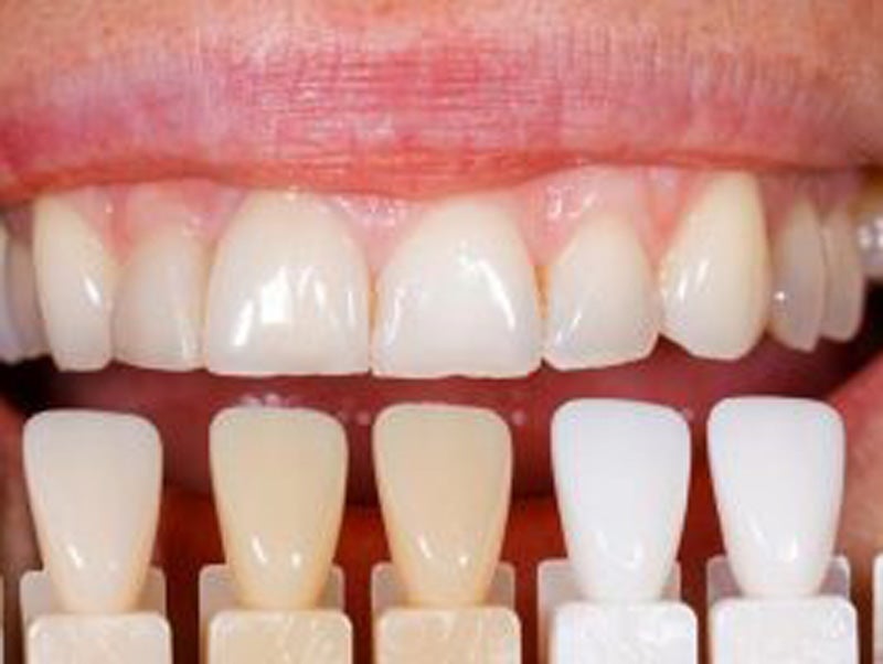 Featured image for “Get Instant Smile Makeover with Porcelain Veneers”