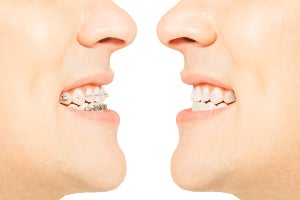 Featured image for “How Clear Aligners Differ from Braces”
