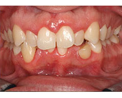 teeth before