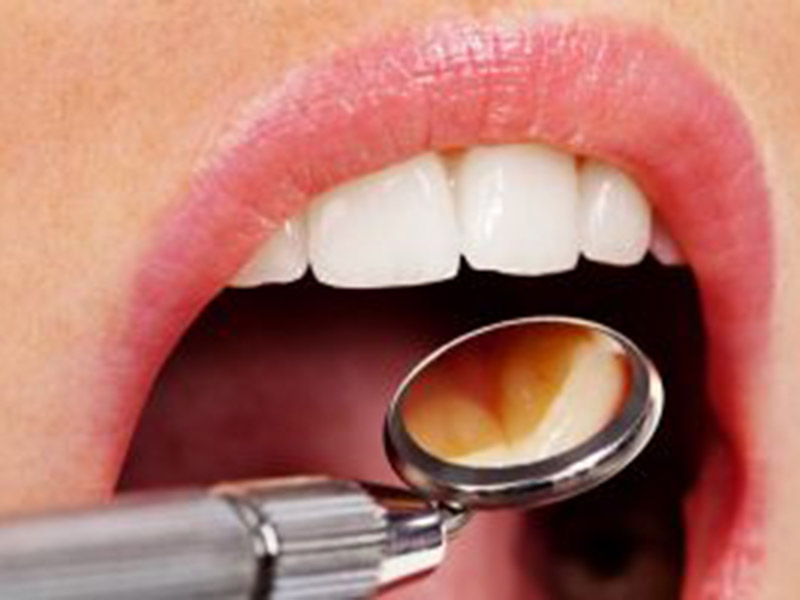 Featured image for “Myths About Treatment for Root Canals in Phoenix”