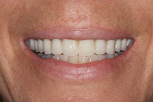 after implant supported dentures