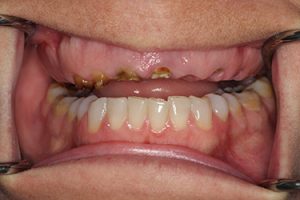 Before the Implant Treatment