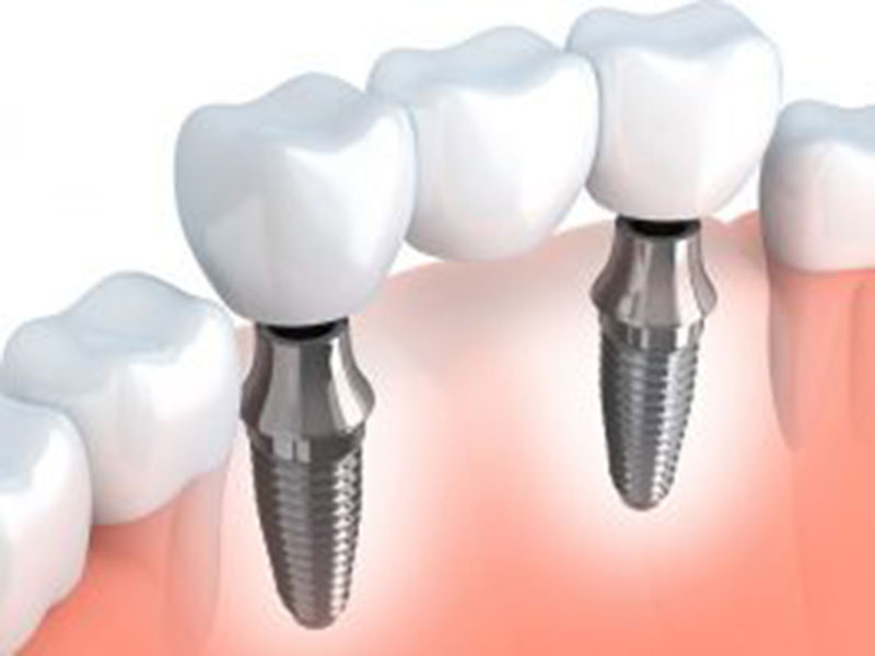 Featured image for “The Pros and Cons of Implant Dentistry in the Phoenix Area”