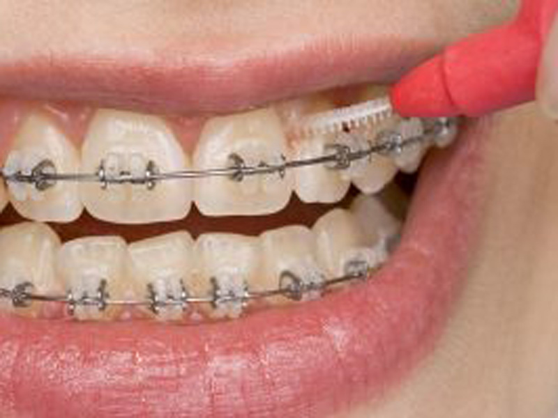 Featured image for “The Benefits of Traditional Braces in Phoenix AZ”