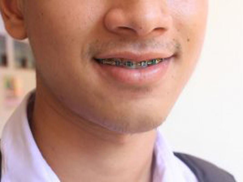 Featured image for “Braces Improve Your Smile and Your Health: An Introduction to Braces”