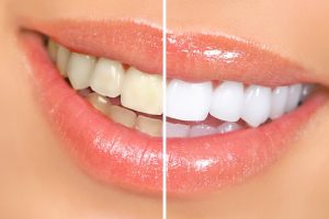 yellow and white teeth difference