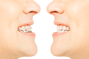 Featured image for “How Clear Aligners Are Different from Braces”