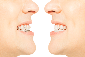 Aligners Vs. Braces in Phoenix, AZ