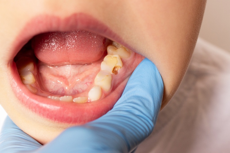 A boy in Phoenix, AZ, finds out dislodged tartar was the reason for a strange chip in his mouth